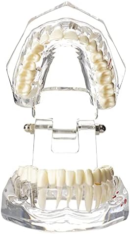 דנטלמאל שיניים דנטלי אוראלי מודל השתלת השתל פתולוגית נשלפת להוראה להוראת הדגמה גלויה להפגנה