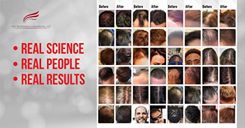 מעבדות לשיקום שיער סרום לעיבוי שיער מרבי, מכיל מרכיבים רבי עוצמה לחסימת דה-דה-טי למניעת נשירת שיער עם תוצאות