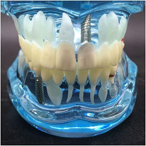 מודל שיניים פתולוגיות של קריסטל KH66ZKY - מודל שיקום שתל - לימוד ילדים, רופא שיניים, תלמידי שיניים, כלי תצוגה
